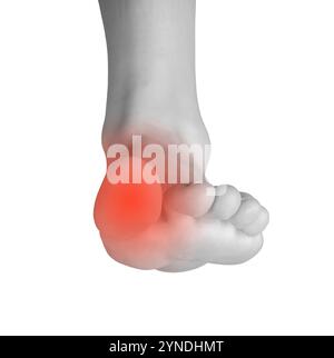 Douleurs et inconfort au pied. Gonflement des orteils et des blessures articulaires avec inflammation, foulure ou crampes causant des douleurs. Accent médical sur la santé, la podologie, ou neu Banque D'Images