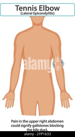 Diagramme montrant l'emplacement de la douleur au tennis elbow Illustration de Vecteur