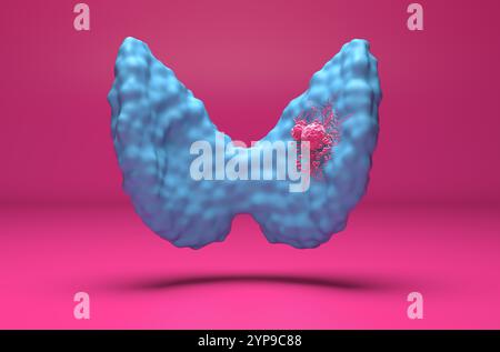 Cellules de cancer de la thyroïde - vue isométrique 3D illustration Banque D'Images