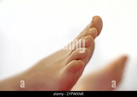 traitement des ongles incarnés. soin des pieds et toilettage Banque D'Images