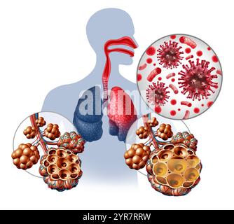 Maladie respiratoire aiguë ou ARD affectant différentes parties des voies respiratoires, y compris les voies respiratoires du nez, de la gorge et les poumons infectés par une BA virale Banque D'Images