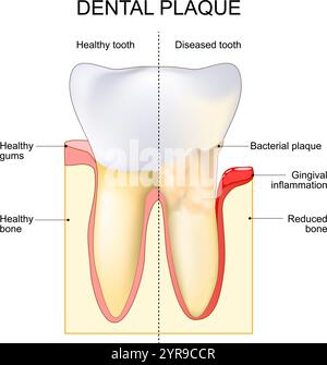 La plaque dentaire. Inflammation gingivale près de la plaque bactérienne. Dent saine et dent malade. Formation de caries. Les parodontopathies. Biofilm oral. BA Illustration de Vecteur