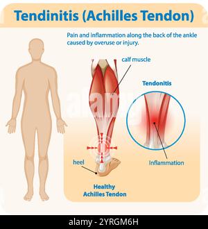 Diagramme montrant l'inflammation et la douleur du tendon d'Achille Illustration de Vecteur