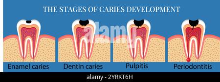 Stades du développement de la carie avec texte Illustration de Vecteur