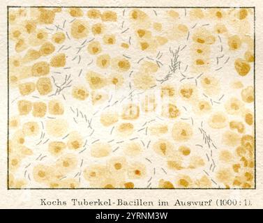 La bactérie tuberculeuse de Koch dans l'expectoration d'un malade au microscope (1000:1). , (Encyclopédie, 1885), Kochs Tuberkel-Bakterien im Auswurf eines Kranken unter dem Mikroskop (1000:1). Banque D'Images