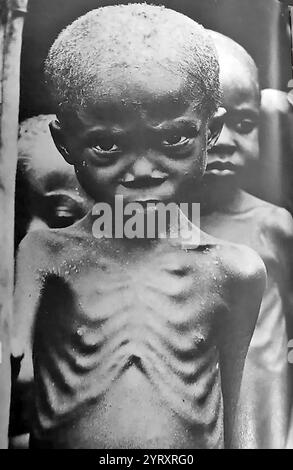 Couverture médiatique de la famine du Biafran pendant la guerre civile nigériane (1967 ? 15 janvier 1970), connue sous le nom de guerre du Biafra, a opposé le Nigeria à la République du Biafra, un État sécessionniste qui avait déclaré son indépendance du Nigeria en 1967. Le Nigeria était dirigé par le général Yakubu Gowon, et le Biafra par le lieutenant-colonel Chukwuemeka 'Emeka' Odumegwu Ojukwu. Le conflit résulte de tensions politiques, ethniques, culturelles et religieuses qui ont précédé la décolonisation officielle du Nigeria par le Royaume-Uni de 1960 à 1963. Les causes immédiates de la guerre en 1966 comprenaient un coup d'État militaire, comte Banque D'Images