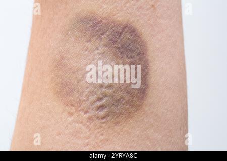 Gros plan d'un gros hématome ou d'un gros hématome se formant sur le bras d'un patient après un traumatisme ou une blessure Banque D'Images