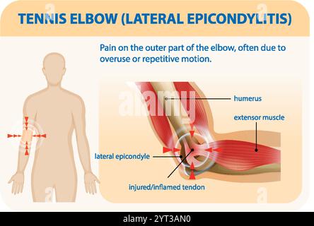 Illustration de la douleur du coude et de l'anatomie musculaire Illustration de Vecteur