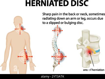 Illustration des hernies discales et des zones douloureuses Illustration de Vecteur