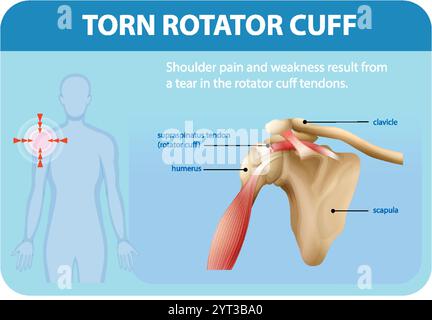 Illustration de l'anatomie de l'épaule et détails de la blessure Illustration de Vecteur
