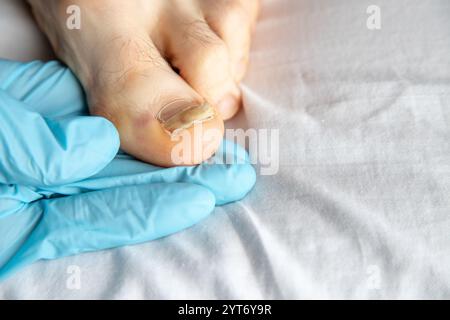 Gros plan d'un ongle d'orteil endommagé examiné par des mains gantées à l'intérieur. Souligne les soins médicaux, l'hygiène et l'attention à une infection fongique possible Banque D'Images