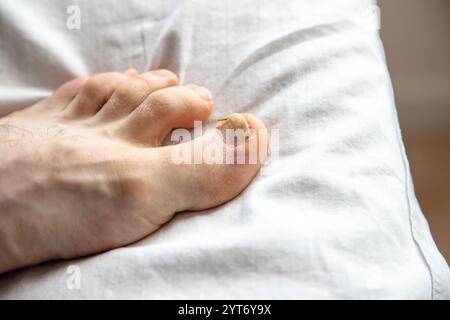 Un gros plan d'un ongle endommagé après un traumatisme, une ecchymose, photographié à l'intérieur sur un fond de tissu. Banque D'Images