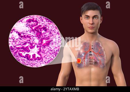 Illustration par ordinateur d'un homme atteint d'un cancer du poumon, accompagnée d'une micrographie légère d'un adénocarcinome du poumon. Banque D'Images