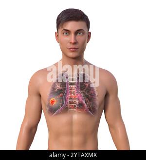 Illustration informatique d'un homme à la peau transparente révélant la présence d'un cancer du poumon. Banque D'Images