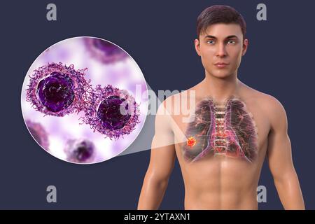 Illustration par ordinateur d'un homme à la peau transparente, révélant la présence d'un cancer du poumon, et vue rapprochée des cellules cancéreuses. Banque D'Images