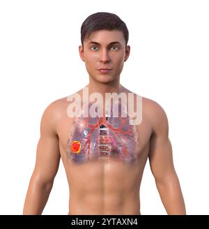 Illustration informatique d'un homme à la peau transparente révélant la présence d'un cancer du poumon. Banque D'Images