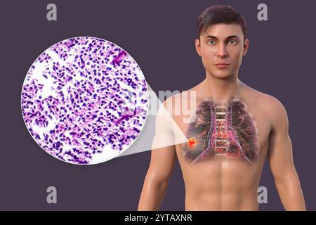 Illustration par ordinateur d'un homme atteint d'un cancer du poumon, avec une micrographie légère d'un cancer du poumon à petites cellules. Banque D'Images