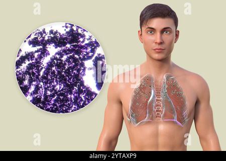 Illustration par ordinateur et micrographie lumineuse d'un homme aux poumons atteints de silicose révélant des nodules silicotiques foncés. Banque D'Images