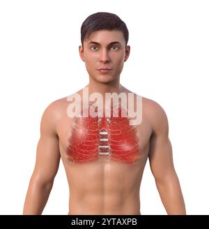 Illustration informatique d'un homme à peau transparente révélant les poumons atteints de miliaire tuberculeuse. Banque D'Images