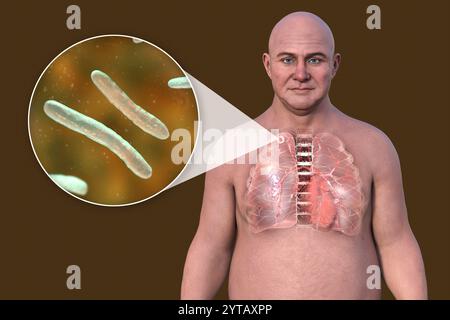 Illustration informatique d'un homme à la peau transparente révélant les poumons atteints de tuberculose secondaire et vue rapprochée de la bactérie Mycobacterium tuberculosis. Banque D'Images
