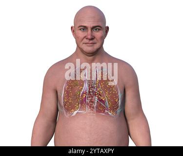 Illustration informatique d'un homme à peau transparente révélant les poumons atteints de miliaire tuberculeuse. Banque D'Images