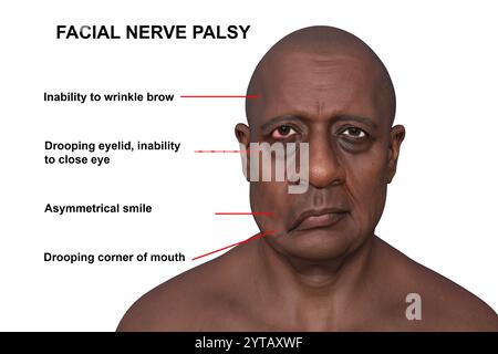 Paralysie faciale chez l'homme. Illustration par ordinateur mettant en évidence l'asymétrie et la chute des muscles faciaux d'un côté du visage dans la paralysie faciale. Banque D'Images