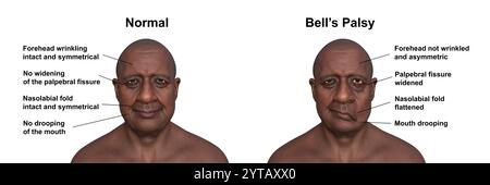 Paralysie faciale chez un homme, et la même personne saine. Illustration par ordinateur mettant en évidence l'asymétrie et la chute des muscles faciaux d'un côté du visage dans la paralysie faciale. Banque D'Images