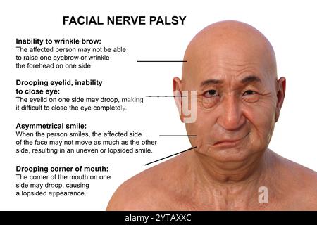 Paralysie faciale chez l'homme. Illustration par ordinateur mettant en évidence l'asymétrie et la chute des muscles faciaux d'un côté du visage dans la paralysie faciale. Banque D'Images