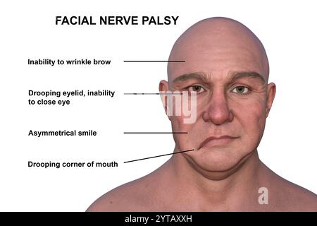 Paralysie faciale chez l'homme. Illustration par ordinateur mettant en évidence l'asymétrie et la chute des muscles faciaux d'un côté du visage dans la paralysie faciale. Banque D'Images