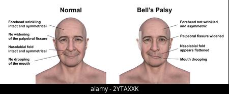 Paralysie faciale chez un homme, et la même personne saine. Illustration par ordinateur mettant en évidence l'asymétrie et la chute des muscles faciaux d'un côté du visage dans la paralysie faciale. Banque D'Images