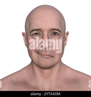 Paralysie faciale chez l'homme. Illustration par ordinateur mettant en évidence l'asymétrie et la chute des muscles faciaux d'un côté du visage dans la paralysie faciale. Banque D'Images