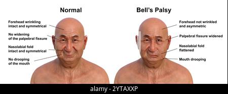 Paralysie faciale chez un homme, et la même personne saine. Illustration par ordinateur mettant en évidence l'asymétrie et la chute des muscles faciaux d'un côté du visage dans la paralysie faciale. Banque D'Images