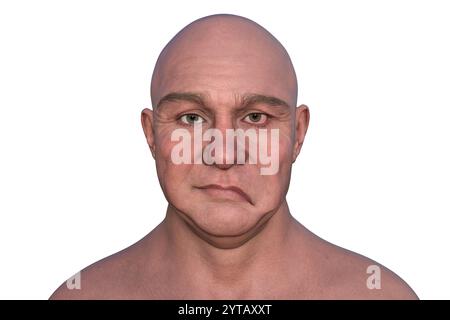 Paralysie faciale chez l'homme. Illustration par ordinateur mettant en évidence l'asymétrie et la chute des muscles faciaux d'un côté du visage dans la paralysie faciale. Banque D'Images