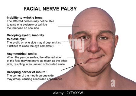 Paralysie faciale chez l'homme. Illustration par ordinateur mettant en évidence l'asymétrie et la chute des muscles faciaux d'un côté du visage dans la paralysie faciale. Banque D'Images