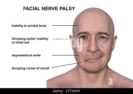 Paralysie faciale chez l'homme. Illustration par ordinateur mettant en évidence l'asymétrie et la chute des muscles faciaux d'un côté du visage dans la paralysie faciale. Banque D'Images