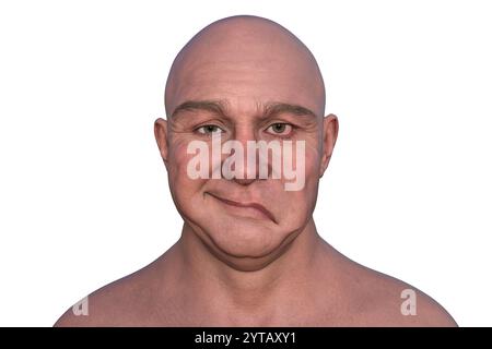 Paralysie faciale chez l'homme. Illustration par ordinateur mettant en évidence l'asymétrie et la chute des muscles faciaux d'un côté du visage dans la paralysie faciale. Banque D'Images