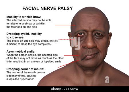 Paralysie faciale chez l'homme. Illustration par ordinateur mettant en évidence l'asymétrie et la chute des muscles faciaux d'un côté du visage dans la paralysie faciale. Banque D'Images