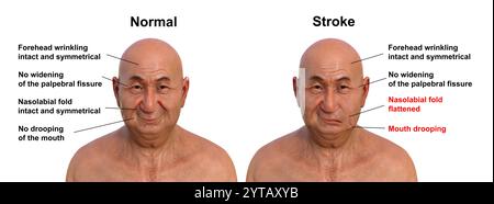 Illustration par ordinateur d'un homme montrant un accident vasculaire cérébral du côté gauche, avec une bouche tombante et un pli nasolabial plat, et la même personne en bonne santé. Banque D'Images
