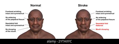 Illustration par ordinateur d'un homme montrant un accident vasculaire cérébral du côté gauche, avec une bouche tombante et un pli nasolabial plat, et la même personne en bonne santé. Banque D'Images