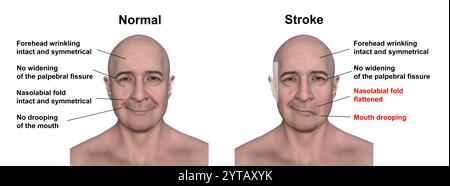 Illustration par ordinateur d'un homme montrant un accident vasculaire cérébral du côté gauche, avec une bouche tombante et un pli nasolabial plat, et la même personne en bonne santé. Banque D'Images