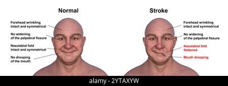 Illustration par ordinateur d'un homme montrant un accident vasculaire cérébral du côté gauche, avec une bouche tombante et un pli nasolabial plat, et la même personne en bonne santé. Banque D'Images