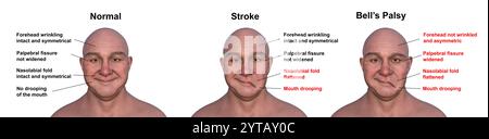 Illustration informatique d'un homme montrant un accident vasculaire cérébral à gauche (centre), une paralysie faciale (gauche) et la même personne en bonne santé (droite). Banque D'Images