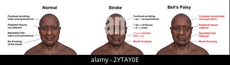 Illustration informatique d'un homme montrant un accident vasculaire cérébral gauche (centre), une paralysie faciale (droite) et la même personne en bonne santé (gauche). Banque D'Images