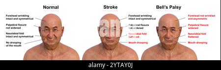 Illustration informatique d'un homme montrant un accident vasculaire cérébral gauche (centre), une paralysie faciale (droite) et la même personne en bonne santé (gauche). Banque D'Images