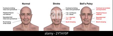 Illustration informatique d'un homme montrant un accident vasculaire cérébral gauche (centre), une paralysie faciale (droite) et la même personne en bonne santé (gauche). Banque D'Images