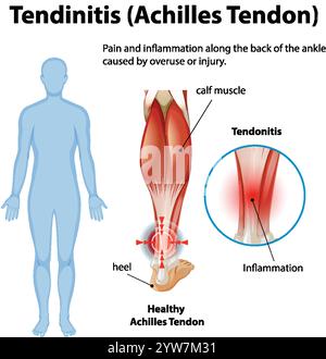 Diagramme montrant l'inflammation et la douleur du tendon d'Achille Illustration de Vecteur