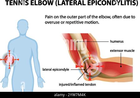 Illustration des symptômes du tennis elbow et des zones touchées Illustration de Vecteur