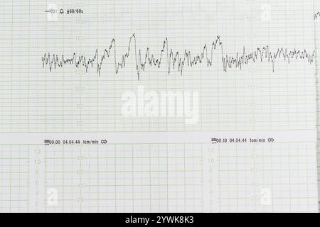 Graphique des résultats médicaux. Lignes irrégulières sur la grille verte. Banque D'Images