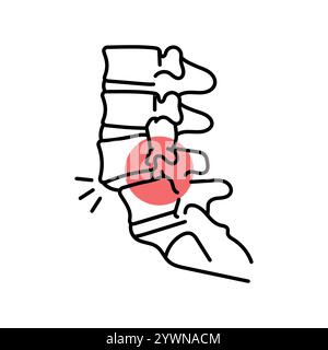 Icône de ligne de couleur de spondylolisthésis. Maladies du rachis. Vertebrology. Elément isolé par vecteur. Contour modifiable. Illustration de Vecteur