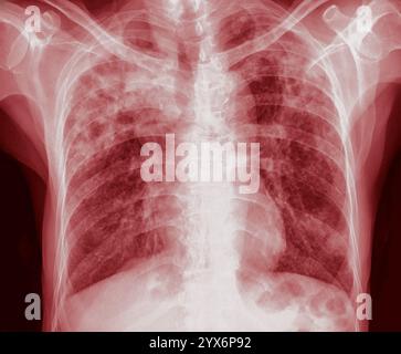 Radiographie colorée des poumons d'un malade atteint de tuberculose pulmonaire affectant les deux poumons. La tuberculose pulmonaire est causée par la bactérie Mycobacterium tuberculosis, qui se propage par la toux et les éternuements. Les bactéries créent des tubercules primaires, des lésions nodulaires des poumons. Les symptômes comprennent la fièvre, la perte de poids et la toux de sang. Le traitement est avec des antibiotiques à long terme. Banque D'Images